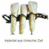 Implantat aus römischer Zeit