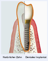 natürlicher Zahn | dentales Implantat